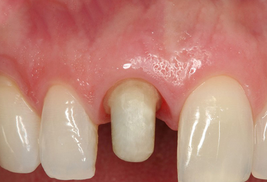 Bọc răng sứ mài nhỏ và những biến chứng nguy hiểm không thể lường trước